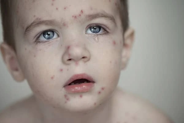 1 yasindan kucuk bebeklerde su cicegi belirtileri ve tedavisi 3