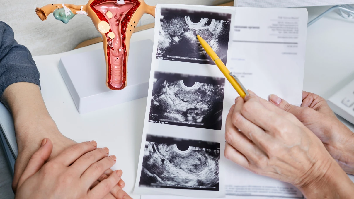 Polikistik Over Sendromu 2