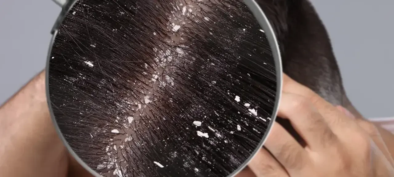 95 sactaki kepek neden olur uzmanlardan etkili cozum onerileri 3