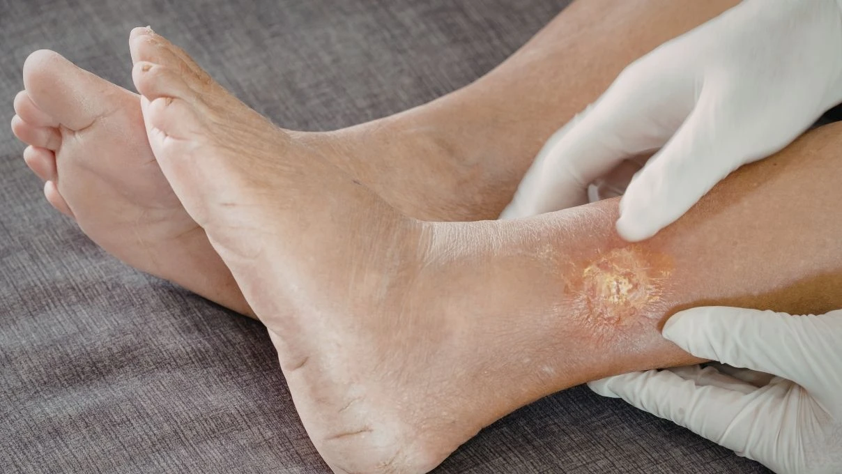 Günümüzün hastalığı ödem! Bütün vücudun mekanizmasını bozuyor