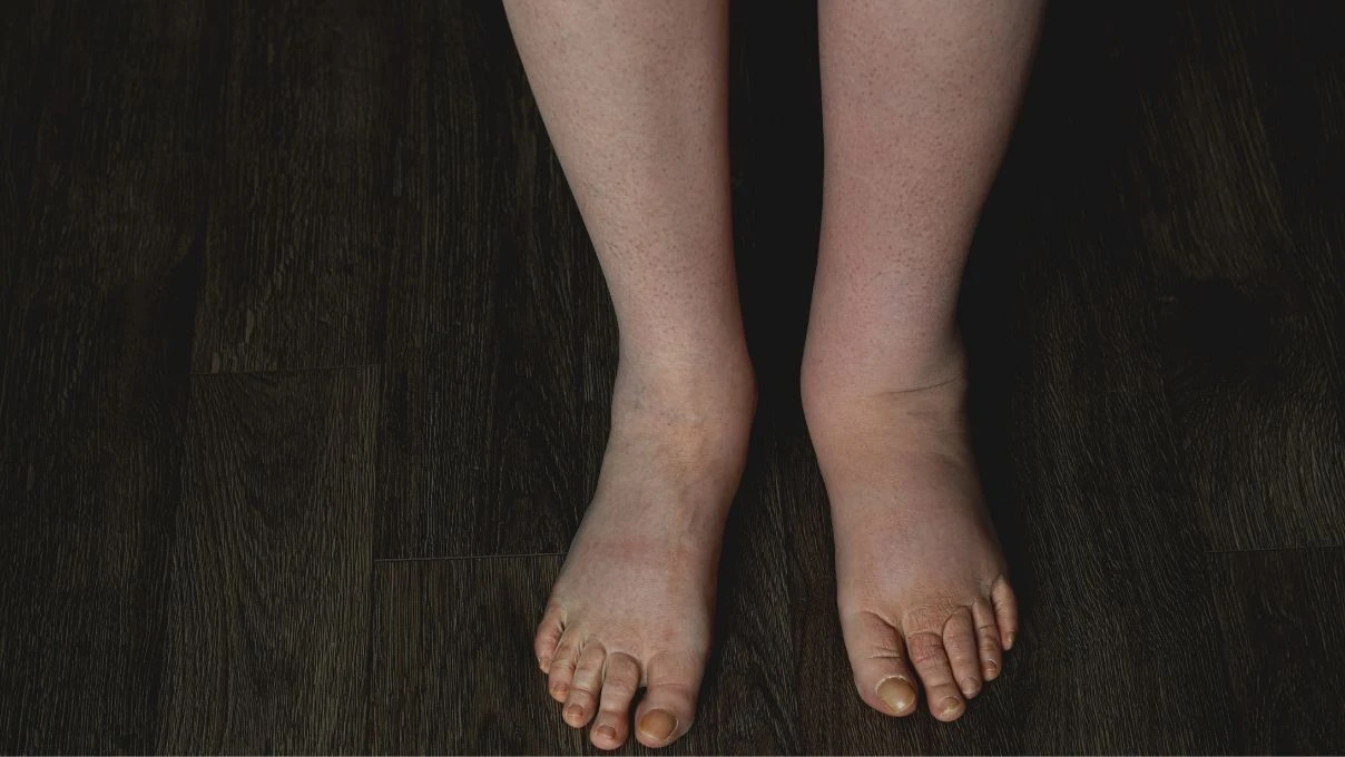 Günümüzün hastalığı ödem! Bütün vücudun mekanizmasını bozuyor