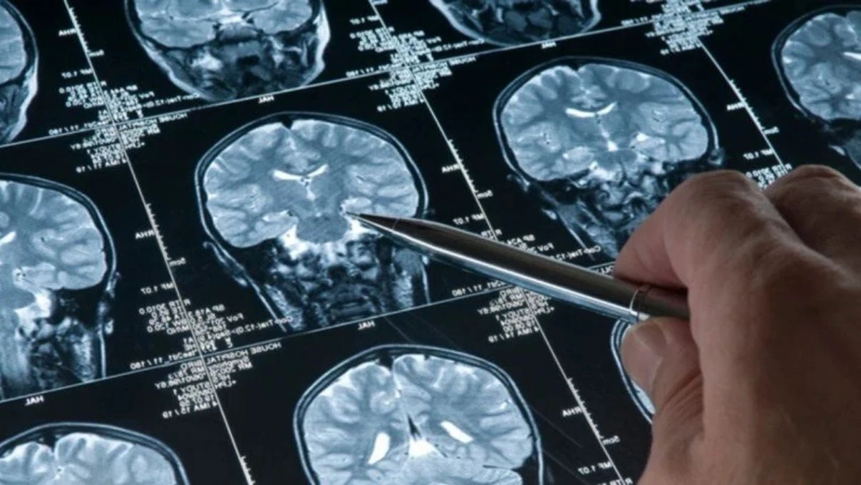 Serdar Ortaç ve daha binlerce kişinin muzdarip olduğu MS hastalığı! İngiltere’nin onay verdiği ilaç 7 Serdar Ortaç ve daha binlerce kişinin muzdarip olduğu MS hastalığı! İngiltere’nin onay verdiği ilaç