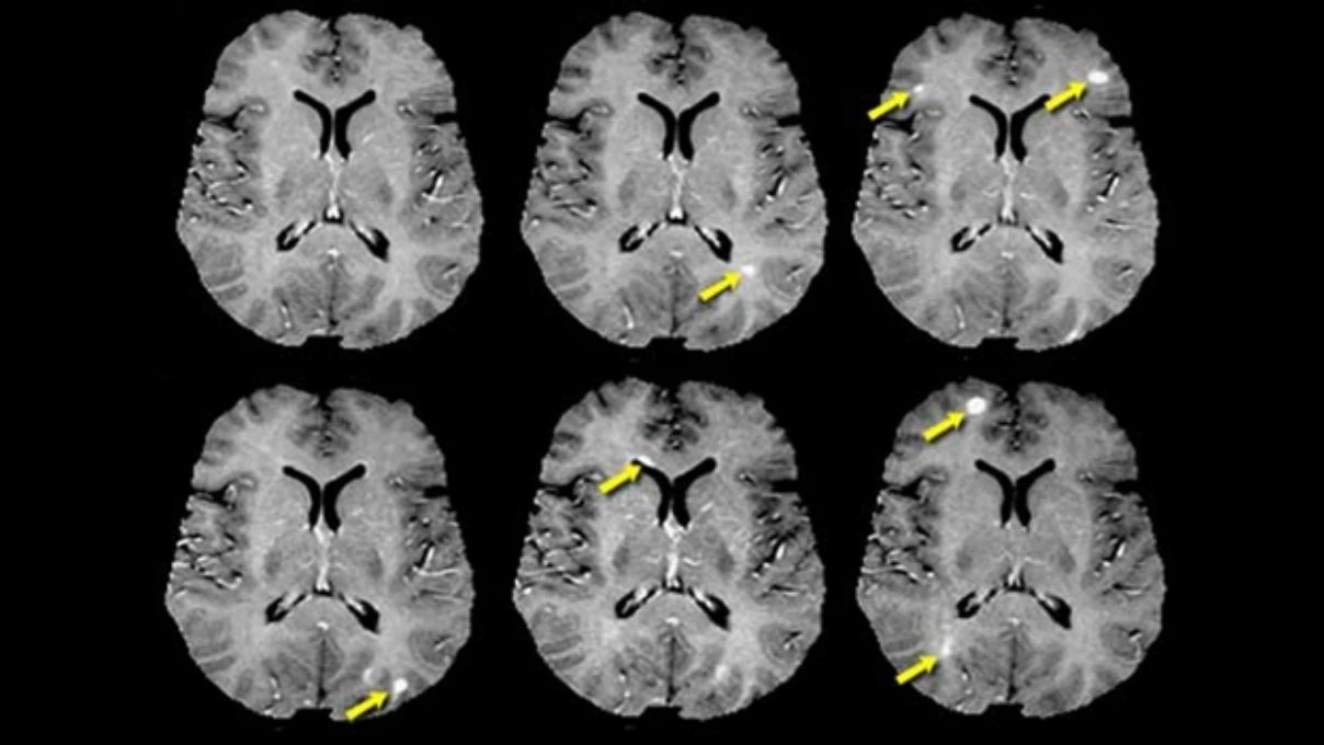 Serdar Ortaç ve daha binlerce kişinin muzdarip olduğu MS hastalığı! İngiltere’nin onay verdiği ilaç 11 Serdar Ortaç ve daha binlerce kişinin muzdarip olduğu MS hastalığı! İngiltere’nin onay verdiği ilaç