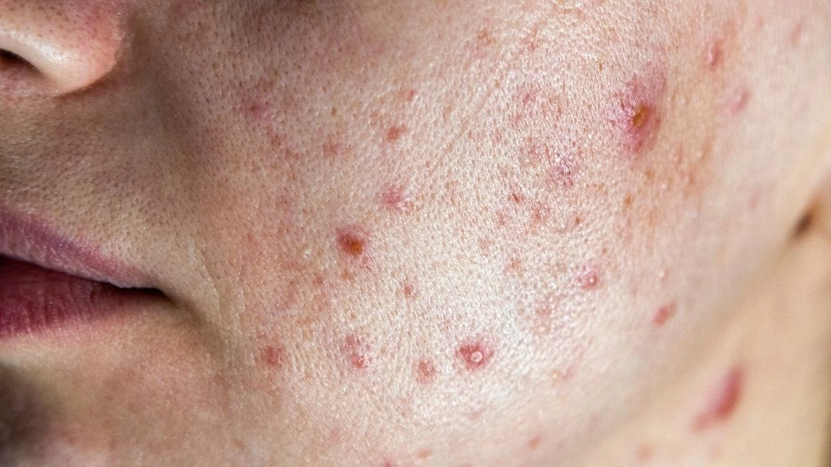 Fotodinamik tedavi acıtıyor mu? Fotodinamik tedavi akne ve lekelere iyi gelir mi?