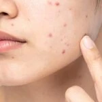 Fotodinamik tedavi acıtıyor mu? Fotodinamik tedavi akne ve lekelere iyi gelir mi?