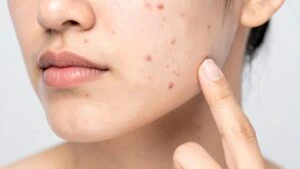 Fotodinamik tedavi acıtıyor mu?