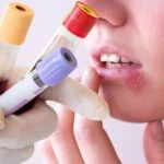 Sık sık uçuk çıkaran kişilere uyarı! Kan değerlerinize mutlaka baktırın