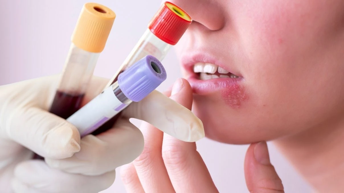 Sık sık uçuk çıkaran kişilere uyarı! Kan değerlerinize mutlaka baktırın