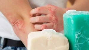 Egzaması olanlara en iyi kalıp sabun markaları 2026!