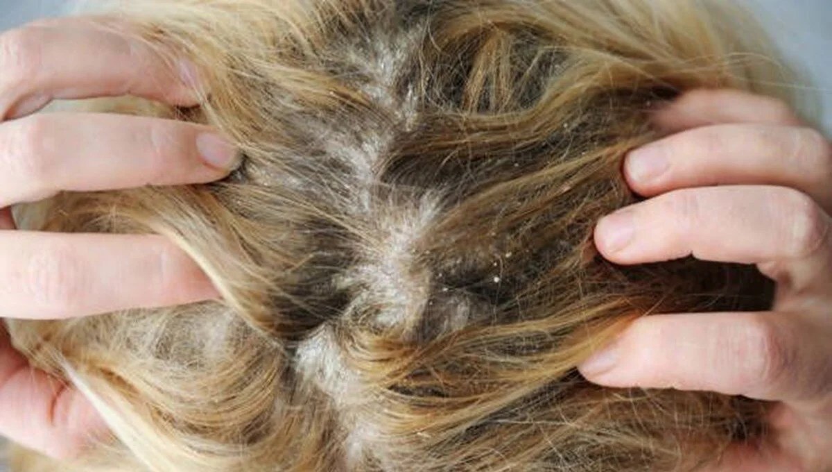 Bitmeyen kepek sorunun altında yatan büyük neden! Banyoda yapılan en büyük hata 6 IP7IBDmHzkSwlbeyAvn6HA