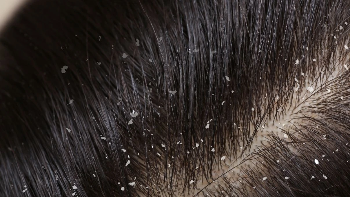 Kepekli saç problemine İbn-i Sina çözümü! Saç derisini temizliyor