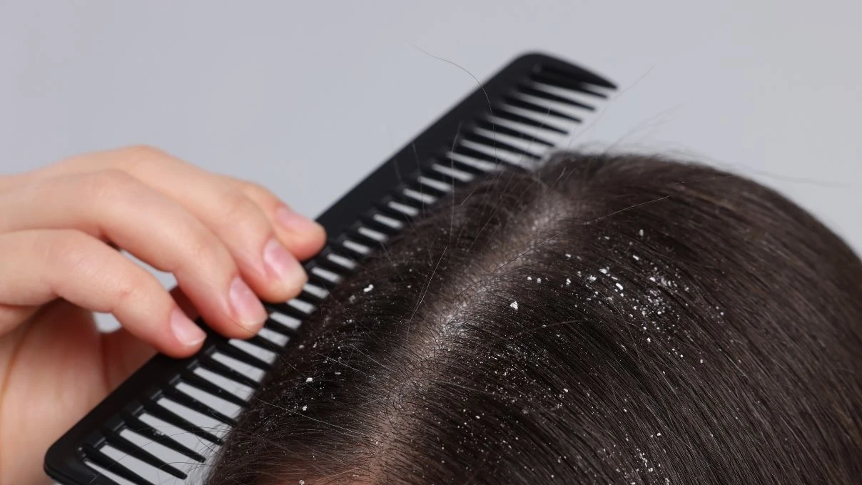 Kepekli saç problemine İbn-i Sina çözümü! Saç derisini temizliyor