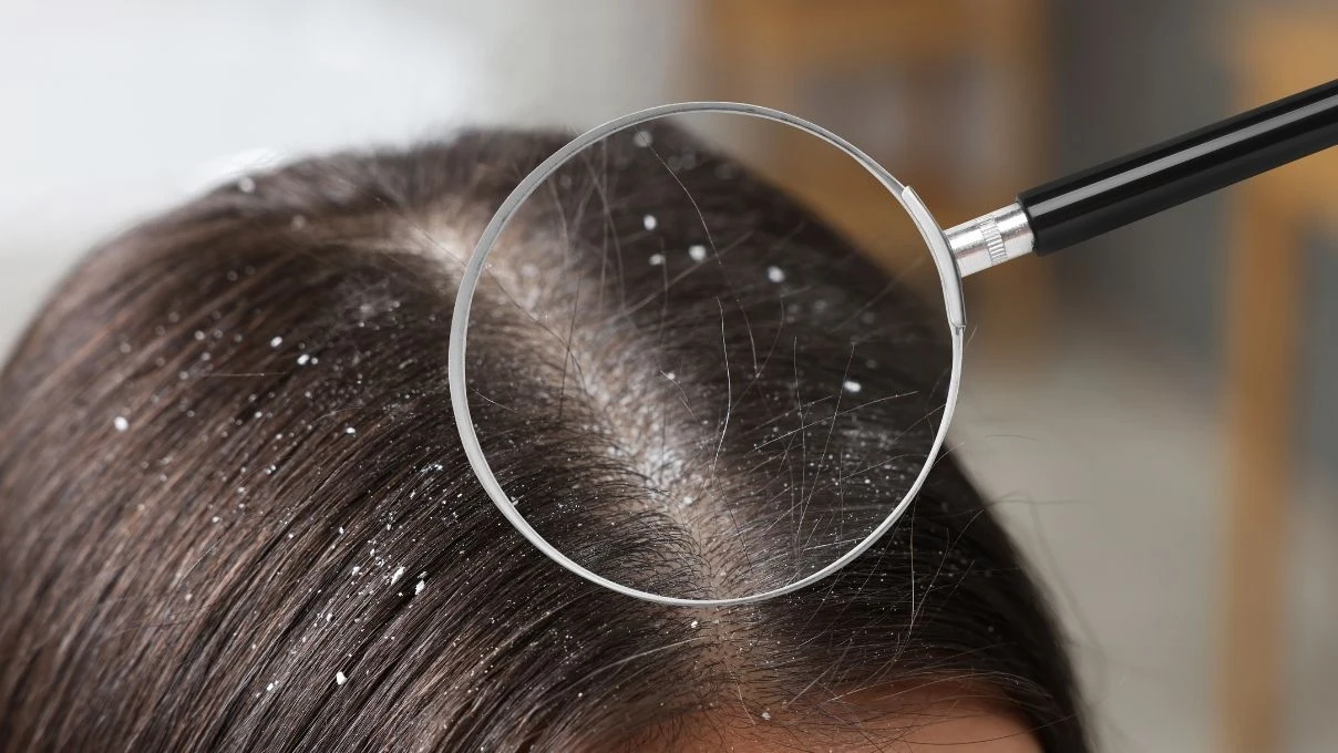 Kepekli saç problemine İbn-i Sina çözümü! Saç derisini temizliyor