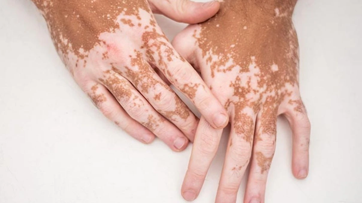 VITILIGO HASTALIGI NEDIR