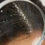 Saç diplerindeki egzamanın en büyük nedeni! Yanlış banyo yapıyorsunuz