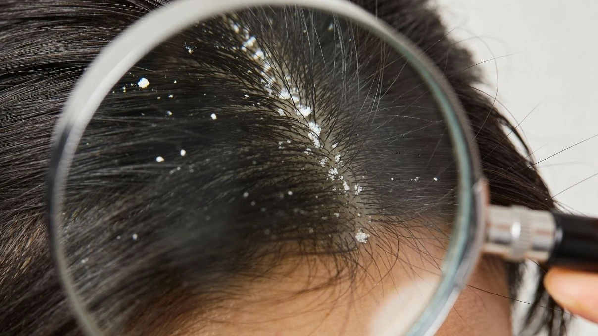 Saç diplerindeki egzamanın en büyük nedeni! Yanlış banyo yapıyorsunuz