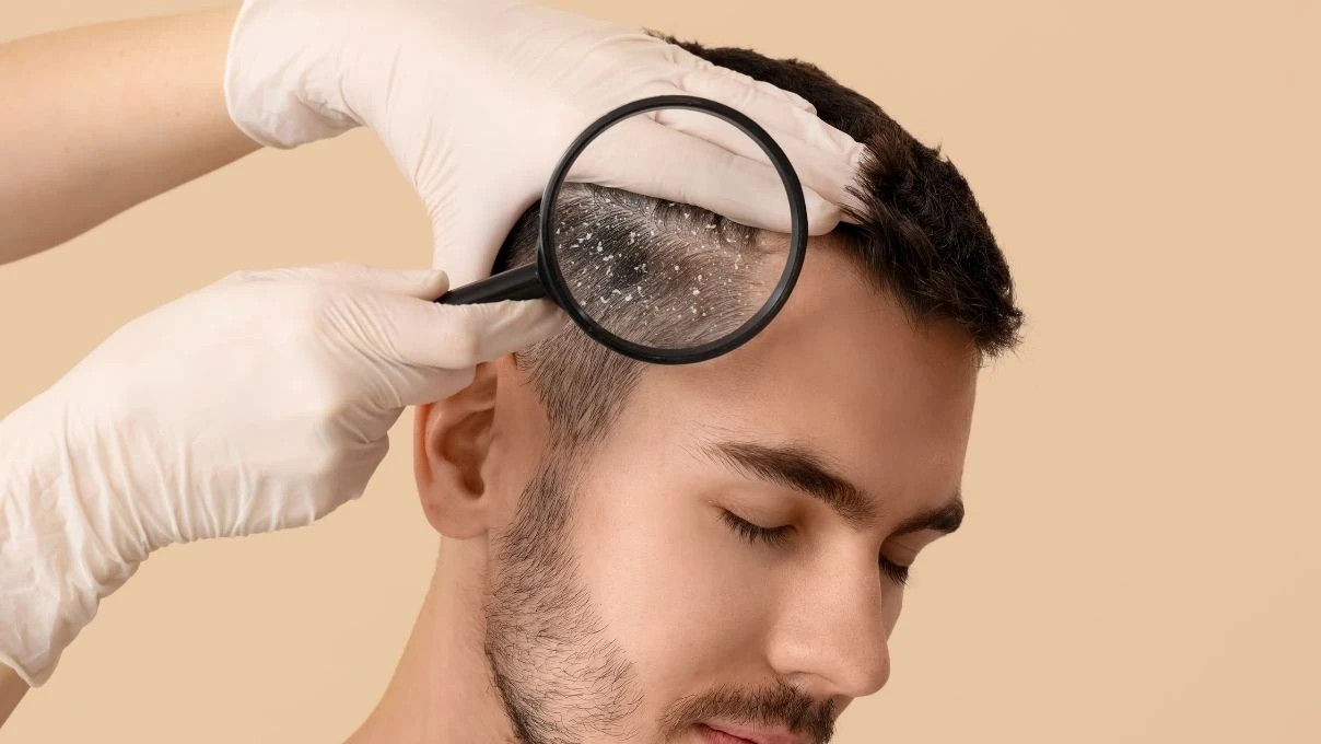 Saç diplerindeki egzamanın en büyük nedeni! Yanlış banyo yapıyorsunuz