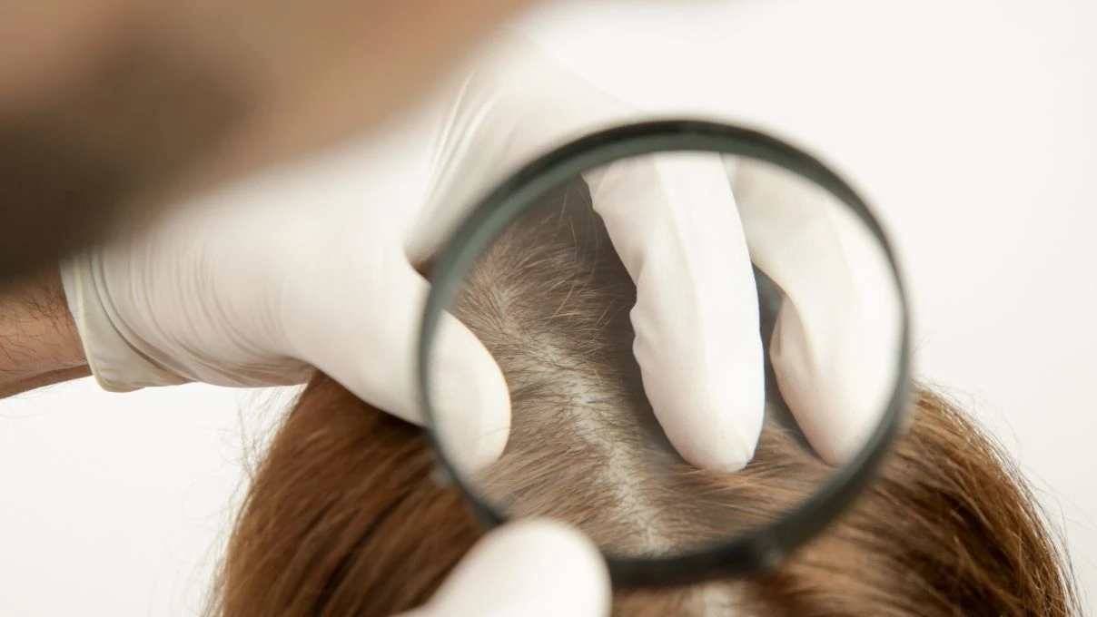 Saç diplerindeki egzamanın en büyük nedeni! Yanlış banyo yapıyorsunuz