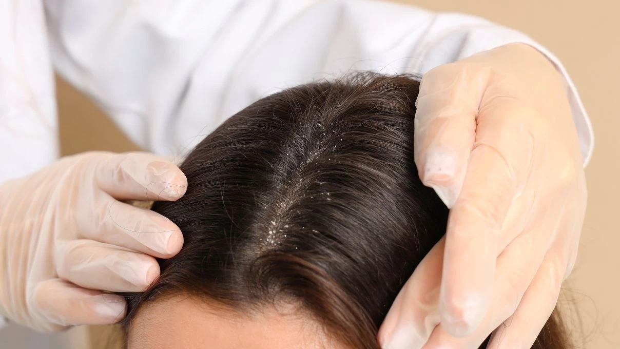 Saç diplerindeki egzamanın en büyük nedeni! Yanlış banyo yapıyorsunuz