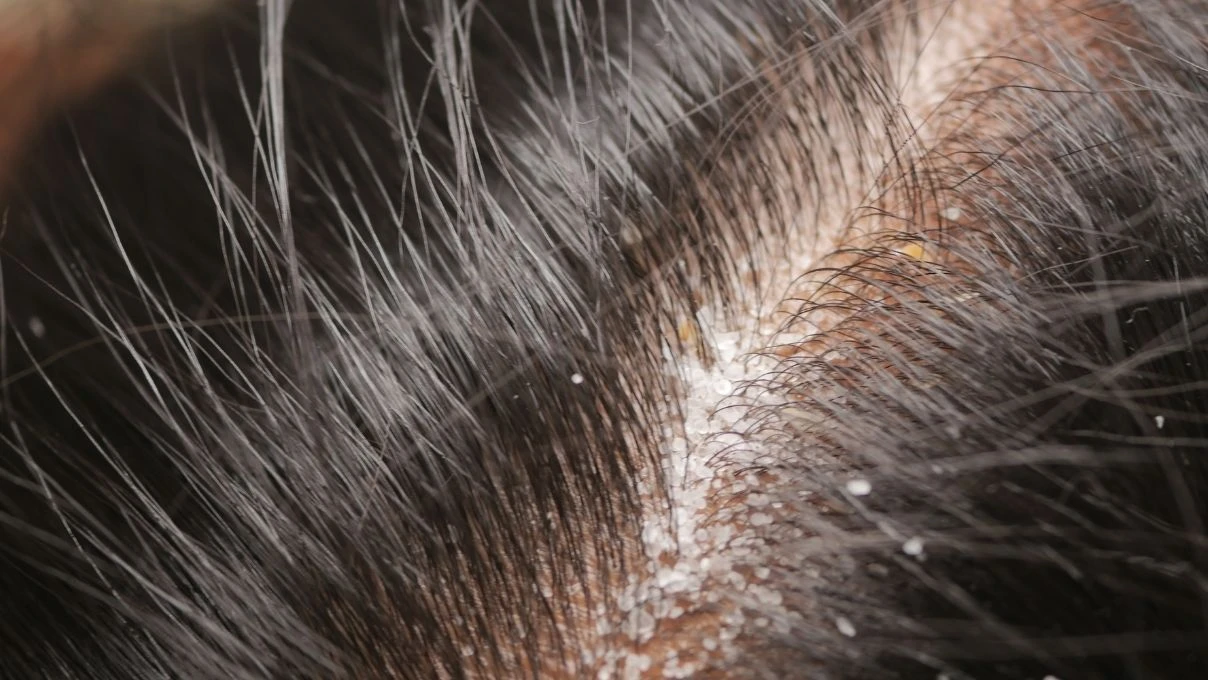 Saç diplerindeki egzamanın en büyük nedeni! Yanlış banyo yapıyorsunuz