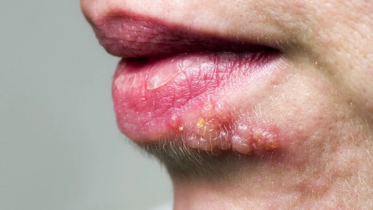 Sık sık uçuk çıkaran kişilere uyarı! Kan değerlerinize mutlaka baktırın