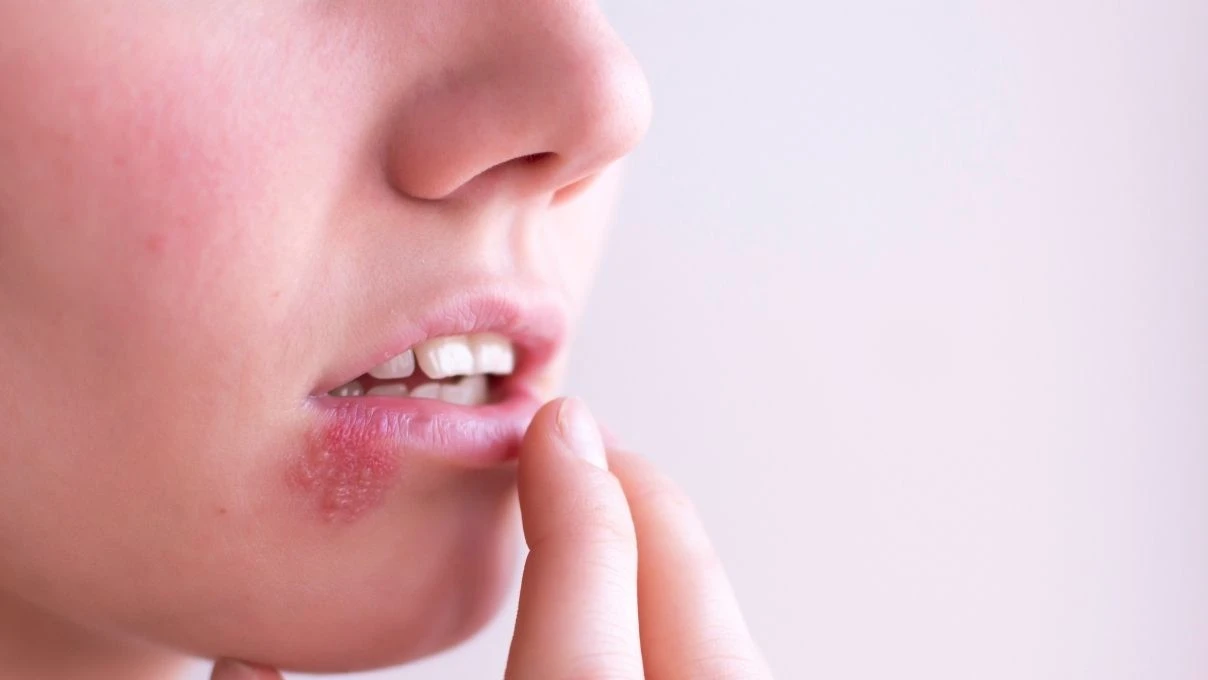 Sık sık uçuk çıkaran kişilere uyarı! Kan değerlerinize mutlaka baktırın