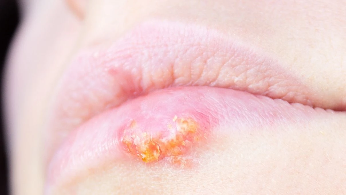 Sık sık uçuk çıkaran kişilere uyarı! Kan değerlerinize mutlaka baktırın