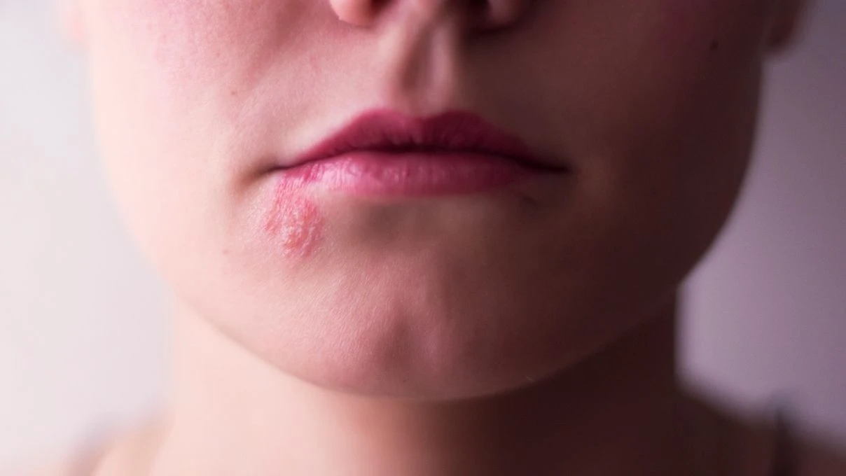 Sık sık uçuk çıkaran kişilere uyarı! Kan değerlerinize mutlaka baktırın