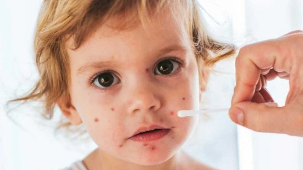 Çocuklarda görülmeye başladı! Zona hastalığının belirtileri