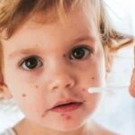 Çocuklarda görülmeye başladı! Zona hastalığının belirtileri