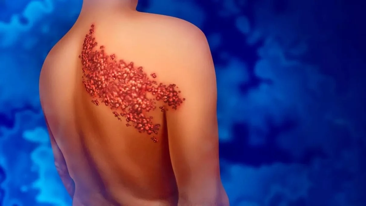 Çocuklarda görülmeye başladı! Zona hastalığının belirtileri