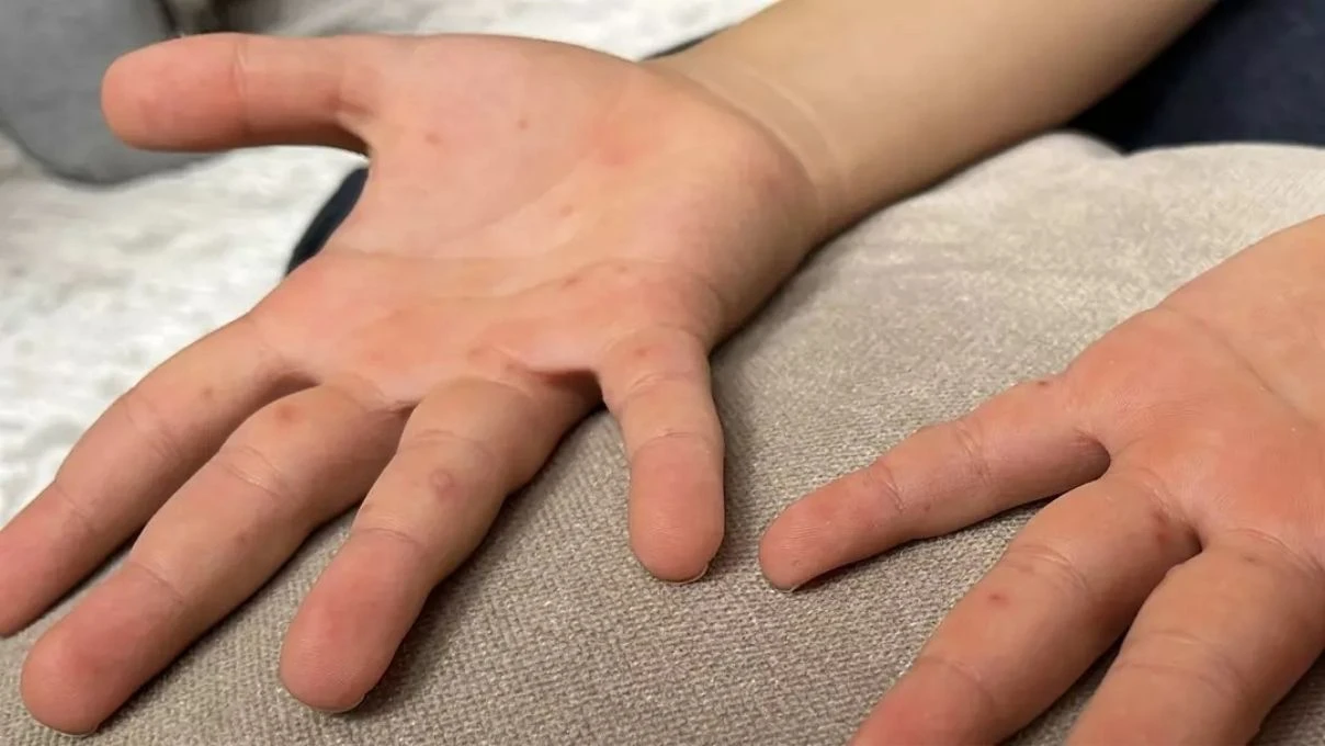 Çocuklarda görülmeye başladı! Zona hastalığının belirtileri