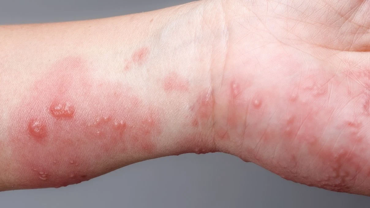 Çocuklarda görülmeye başladı! Zona hastalığının belirtileri