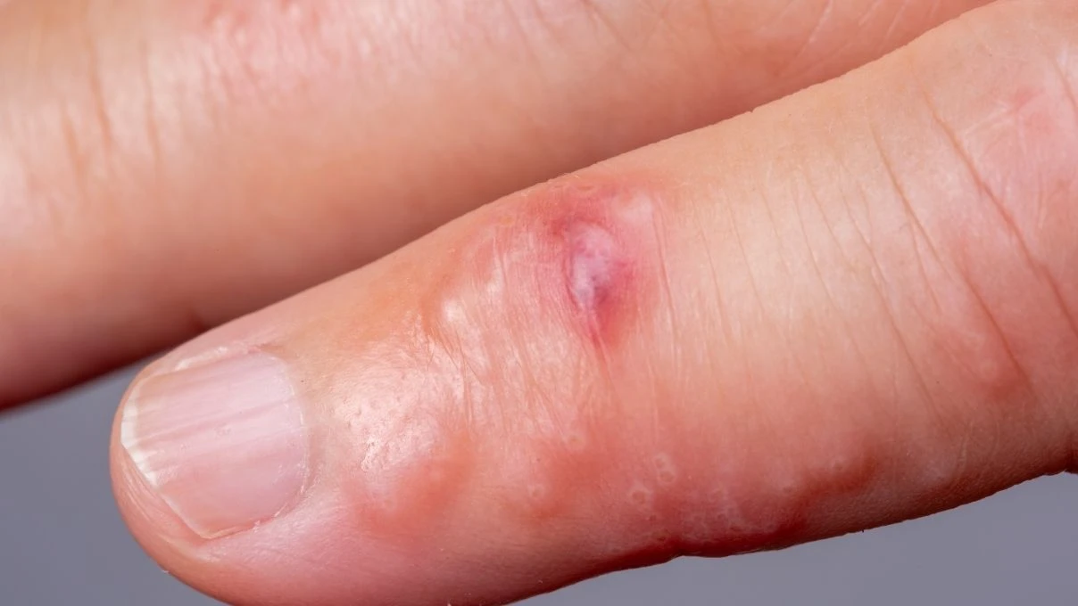 Çocuklarda görülmeye başladı! Zona hastalığının belirtileri