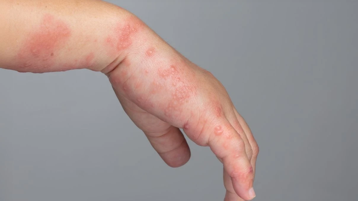 Çocuklarda görülmeye başladı! Zona hastalığının belirtileri