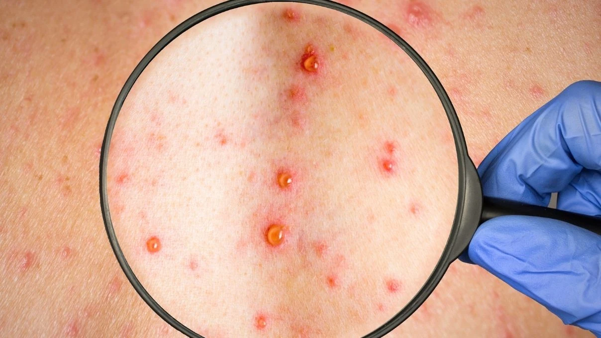 Çocuklarda görülmeye başladı! Zona hastalığının belirtileri