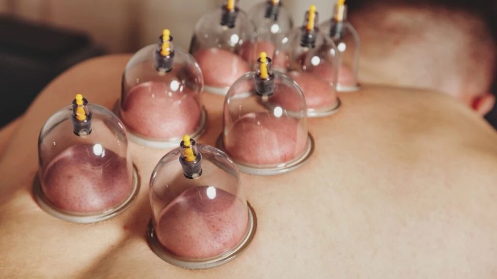 Hacamat nedir, kimlere yapılır? Hacamat neye iyi gelir, faydaları nelerdir?