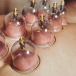 Hacamat nedir, kimlere yapılır? Hacamat neye iyi gelir, faydaları nelerdir?