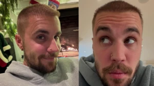 Saç ekimi için ‘Türkiye’ye gitmeliydin’