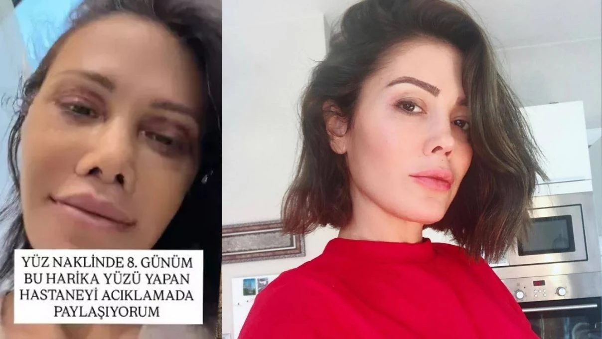 Eski Survivor yarışmacısı Didem Ceran Kore’de yüz nakli oldu! Yeni hali dikkatlerden kaçmadı