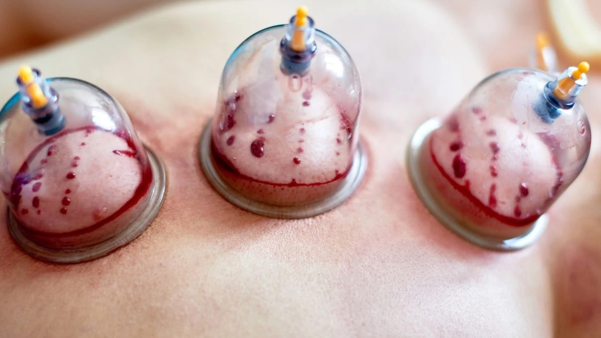 Hacamat nedir, kimlere yapılır? Hacamat neye iyi gelir, faydaları nelerdir?