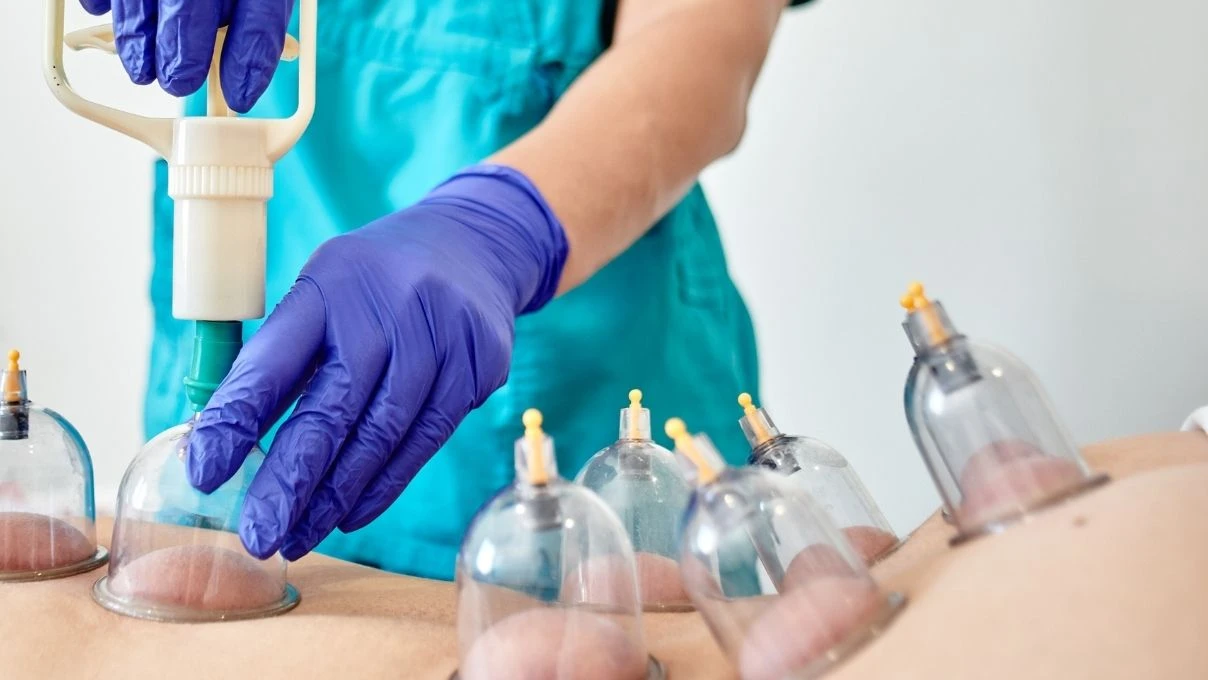 Hacamat nedir, kimlere yapılır? Hacamat neye iyi gelir, faydaları nelerdir?