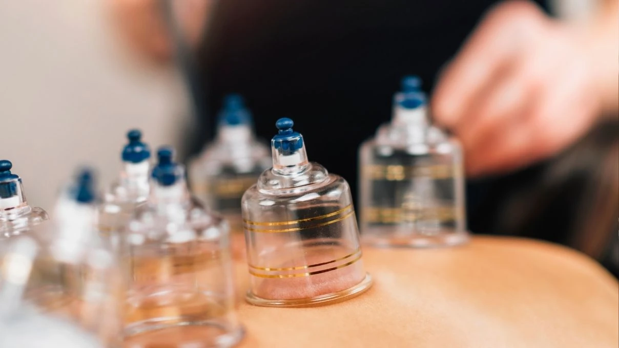 Hacamat nedir, kimlere yapılır? Hacamat neye iyi gelir, faydaları nelerdir?