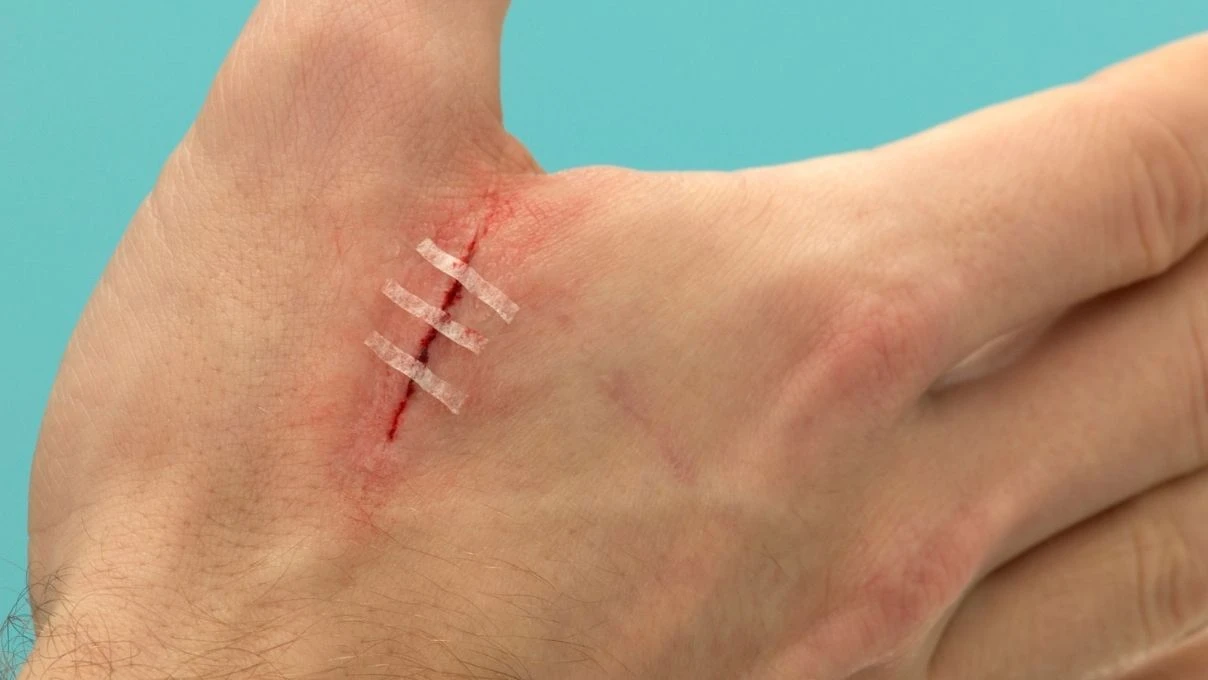 Evde kesik pansumanı nasıl yapılır? Açık yaraya pansuman yaparken nelere dikkat edilmeli?