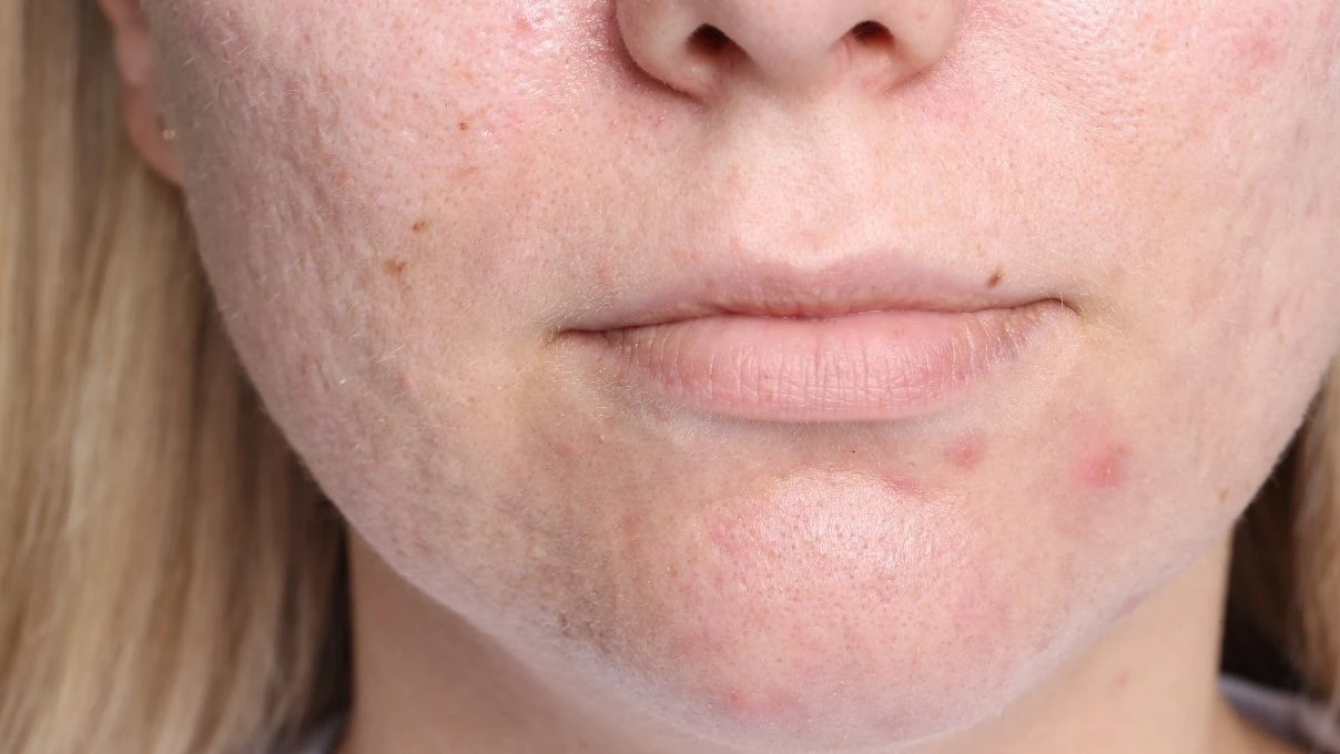 Gözenek küçülten çay! Bu kez sürmüyorsunuz, içiyorsunuz