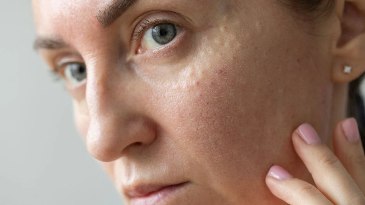 Gözenek küçülten çay! Bu kez sürmüyorsunuz, içiyorsunuz