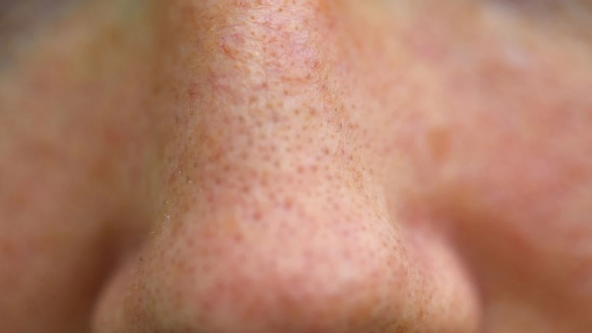 Gözenek küçülten çay! Bu kez sürmüyorsunuz, içiyorsunuz