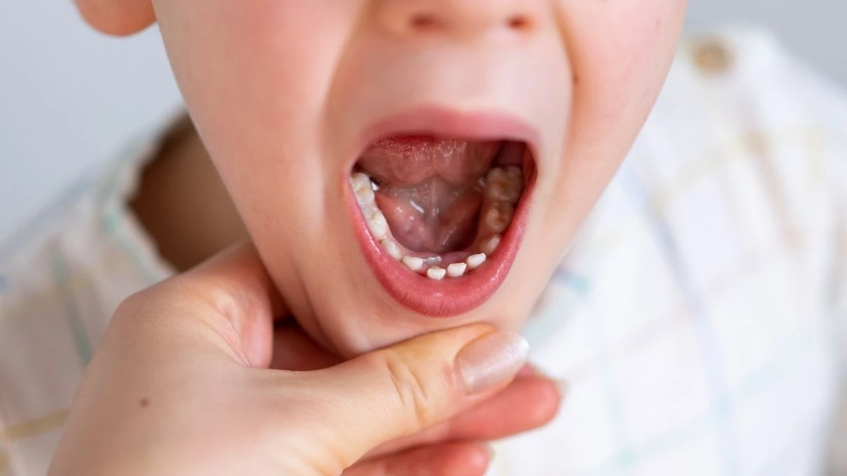Çocuklardaki diş ağrısına dikkat! Çürüyüp çürüyüp dökülmeye son 5 Çocuklardaki diş ağrısına dikkat! Çürüyüp çürüyüp dökülmeye son