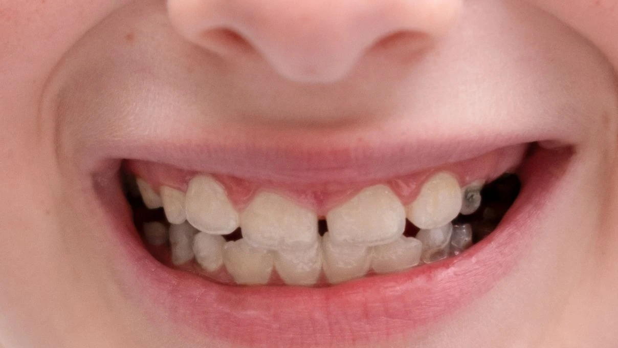 Çocuklardaki diş ağrısına dikkat! Çürüyüp çürüyüp dökülmeye son 13 Çocuklardaki diş ağrısına dikkat! Çürüyüp çürüyüp dökülmeye son