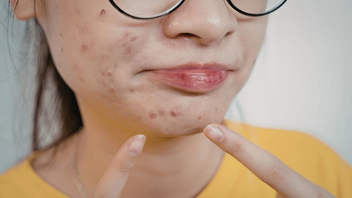 Ciltteki lekelere son! Asırlık cilt tonu eşitleyen maske tarifi